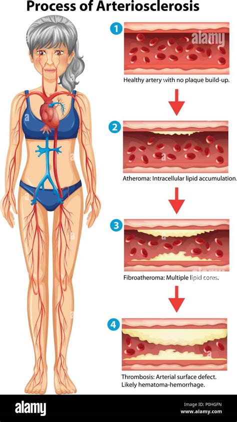 Proceso De Arteriosclerosis Ilustraci N M Dica Imagen Vector De Stock