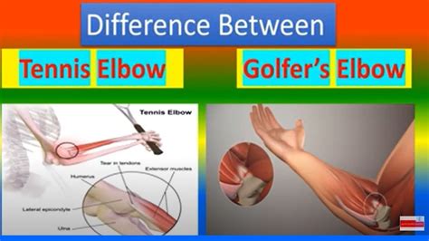 Difference Between Tennis Elbow And Golfers Elbow Youtube