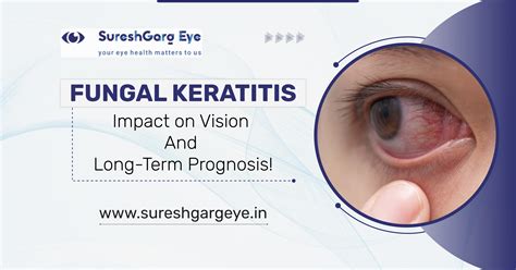 Understanding Fungal Keratitis: Vision Impact & Prognosis Insights