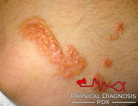 Eruptive Xanthoma Physical Diagnosis Pdx