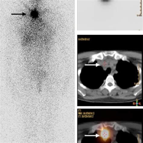 (PDF) 131I SPECT/CT: A one-station imaging modality in the management ...