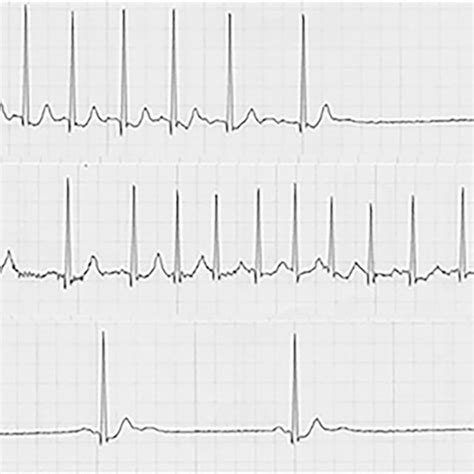 ECG at initial examination. Normal sinus rhythm was shown | Download ...