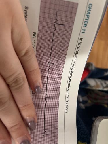 Ecg Flashcards Quizlet