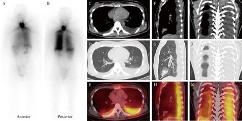 Whole Body Scan A Anterior View B Posterior View On Day Post