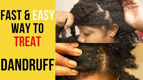 How To Get Rid Of Dandruff Quick And Easy Remedy For Dandruff How