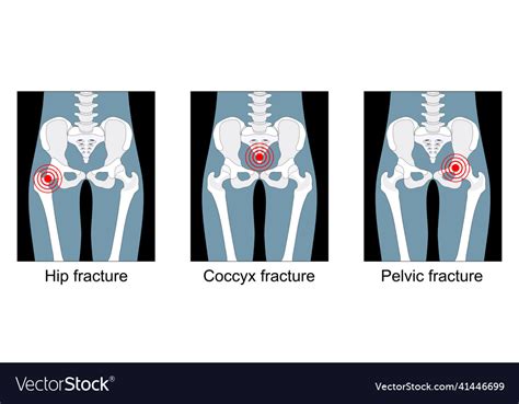 Hip Fracture Symptoms Treatment And Icd 10 Codes Hip