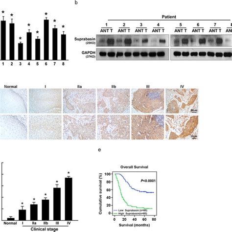 Suprabasin Expression Increases In ESCC Tissues And Correlates With