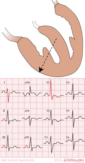 Chamber Hypertrophy And Enlargment Ecgpedia