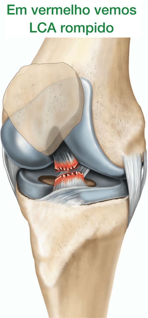 O Que E Lca Cirurgia - Cirurgia LCA - Ligamento Cruzado Anterior - Dr. Thiago Protta
