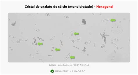 Cristais de oxalato de cálcio na urina: como reconhecer as formas ...