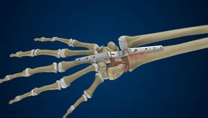 Total Wrist Arthrodesis NSW | Wrist Fusion Surgery NSW