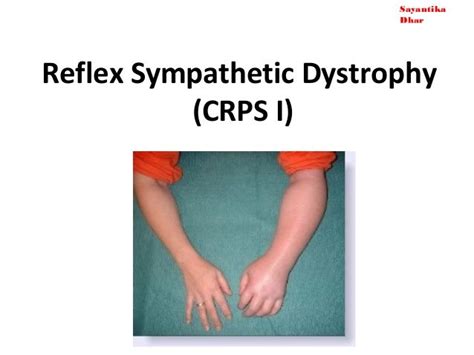 Pin On Complex Regional Pain Syndrome Crps Reflex Sympathetic