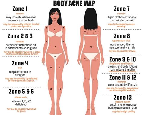 Body acne – Artofit