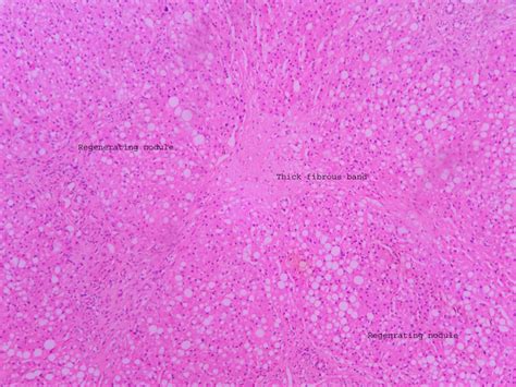 Cirrhosis Histopathologyguru