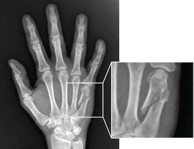 Finger and Hand Fractures