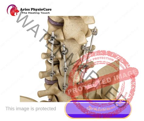spinal fusion aries physiocare