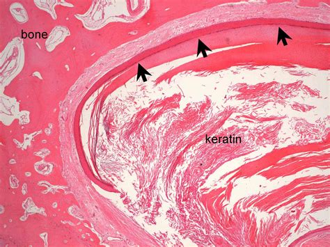 Intraosseous epidermoid cyst in the toe of a dog | Case Study | Cytopath