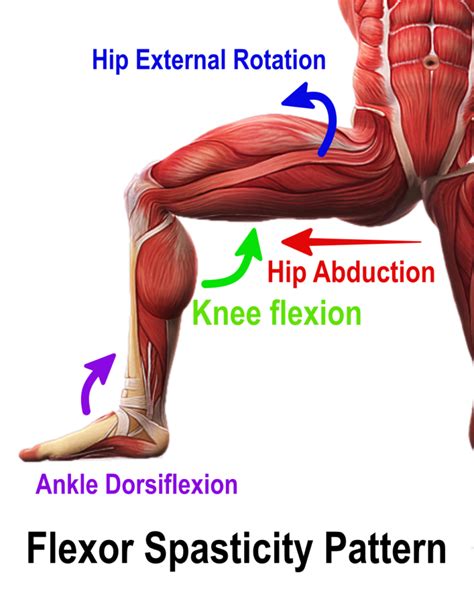 Post Stroke Spasticity What Is The Best Treatment Orlando Neuro Therapy