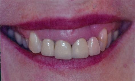 Lumineers Vs Veneers Before After