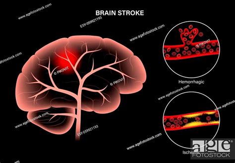 Brain Stroke Hemorrhagic And Ischemic Problem Arteriosclerosis