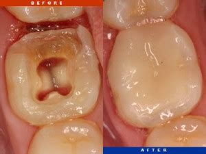 Root Canal Before After Rainbow Dental Centre