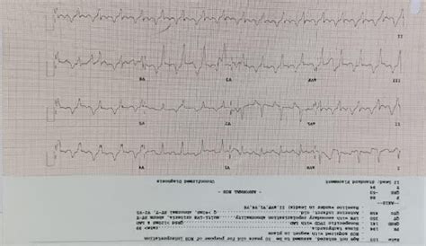 ECG as a Lifesaving Lens: Decoding Hyperkalemia with Dr. Wincy Marlene ...