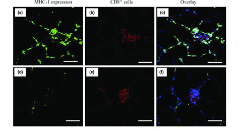 Detection of the CD8 ⁄ MHC-1 complex by double staining for MHC-1 and ...