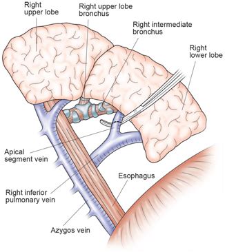 Segmentectomy | Thoracic Key