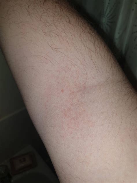 Lamotrigine rash? : BipolarReddit