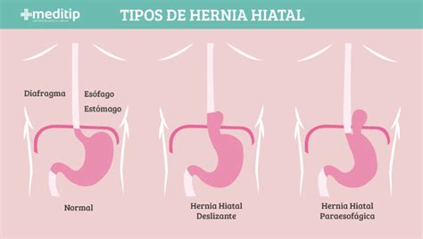 Hernia Hiatal Tipos Causas S Ntomas Y Tratamiento