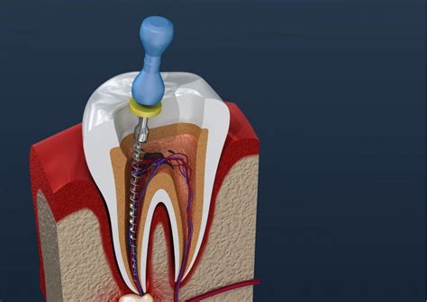 Diente negro después de una endodoncia Clínica Dental Everest