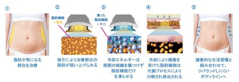 脂肪冷却クラツーα 東京ブランシェクリニック｜麻布十番4050代のシミ取り・しわ取り・プチ整形