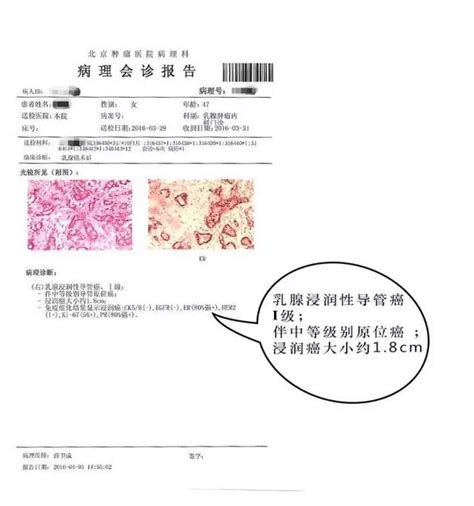 教你一分钟看懂 乳腺癌病理报告单！ Medsci Cn