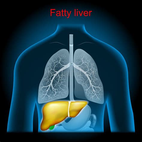 Enfermedad Hep Tica Grasa Esteatosis Hep Tica Ilustraci N Del Vector