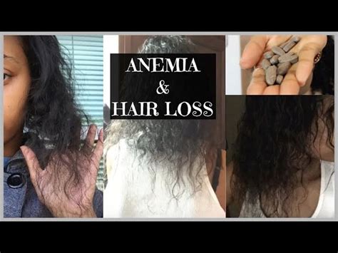 Iron Deficiency Anemia Symptoms Hair Loss - Infoupdate.org