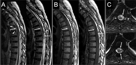 Teaching NeuroImage Spontaneous Idiopathic Spinal Subdural Hematoma