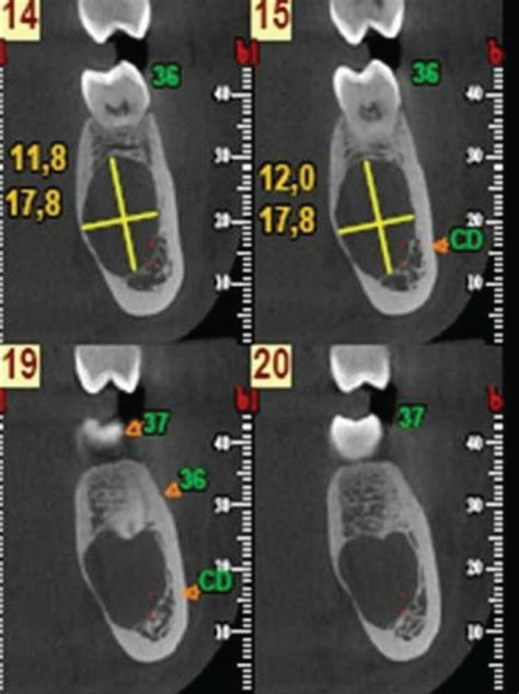 Cone Beam Computerized Tomography A Welldefined Unilocular