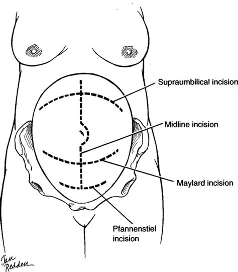 Abdominal Incision And Abdominal Anatomy Images