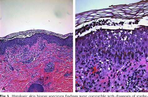 Figure 1 From Staphylococcal Scalded Skin Syndrome And Toxic Shock