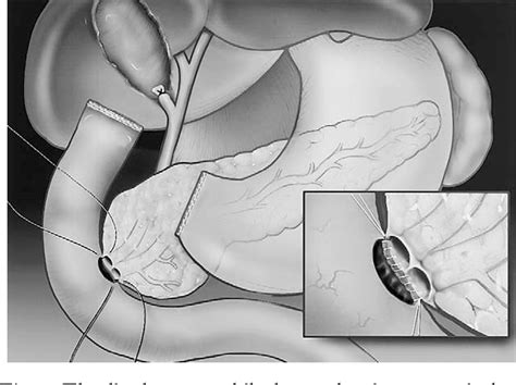 Figure 1 From Pancreas Preserving Duodenectomy In The Management Of Duodenal Familial