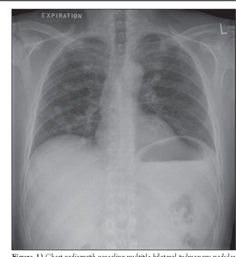 Figure 1 From Granulomatous Pneumocystis Jiroveci Pneumonia Associated With Immune Reconstituted