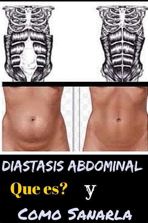 Healthy And Crafty Diastasis Abdominal Que Es Y Como Tratarla