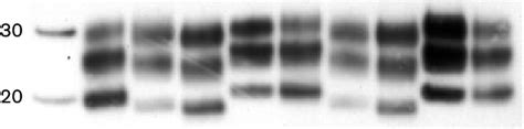 Western Blot Analysis Of Prp Tse In Samples Of Frontal Cortex From Four