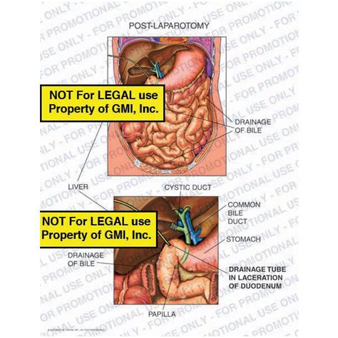 Cholecystectomy Post Op 00054a56a Generic Medical Legal Exhibits A Division Of Mvi