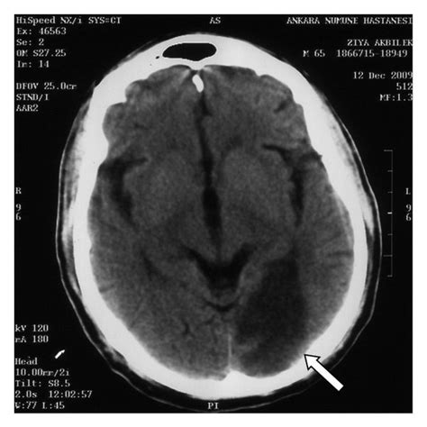 Right Occipital Infarct Area In The Ct Scan White Arrow Download Scientific Diagram