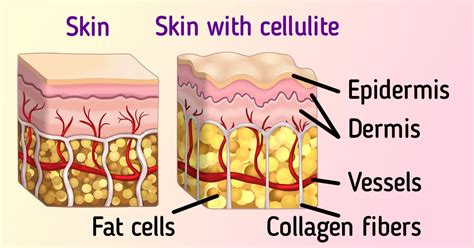 What Cellulite Is And How Its Formed Minute Crafts