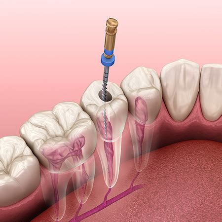 Tratament Endodontic Monoradicular Clinicile DR ALECU