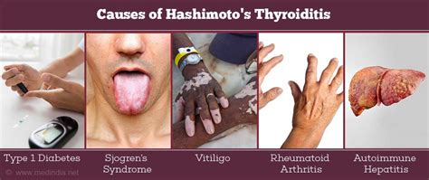 Natural Treatments For Hashimotos Thyroiditis