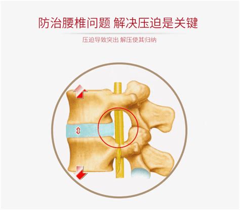 腰椎间盘突出的症状、治疗原则及辅助方法？ 哔哩哔哩