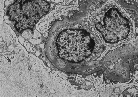 Ajkd Atlas Of Renal Pathology Thrombotic Microangiopathy American